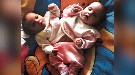 gabby garcia conjoined twin|East Idaho News